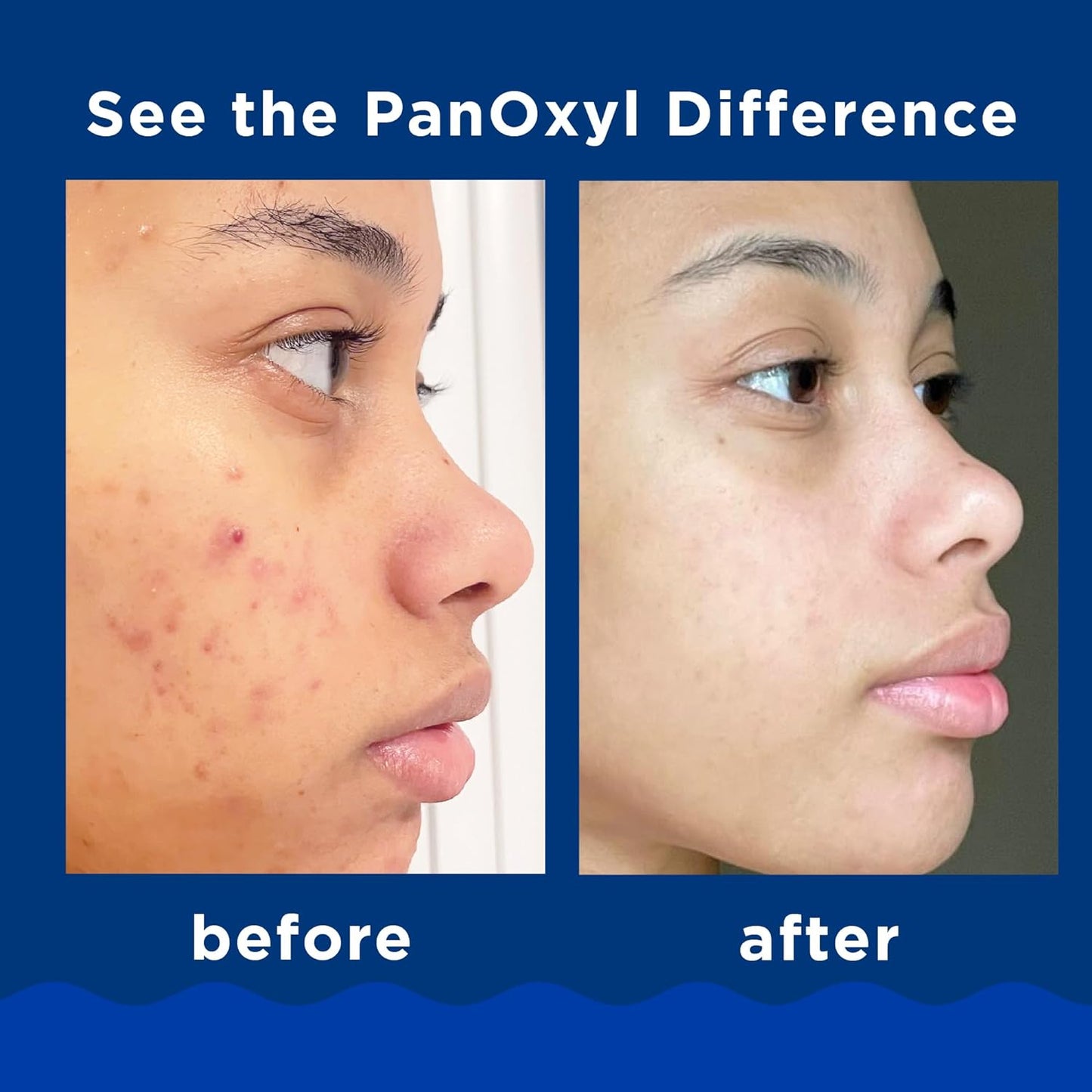 [Panoxyl] Limpiador Facial para piel con Acné 156gr